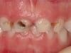 Early Childhood Caries
