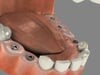 Multiple Tooth Implants