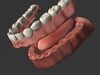 Immediate Dentures